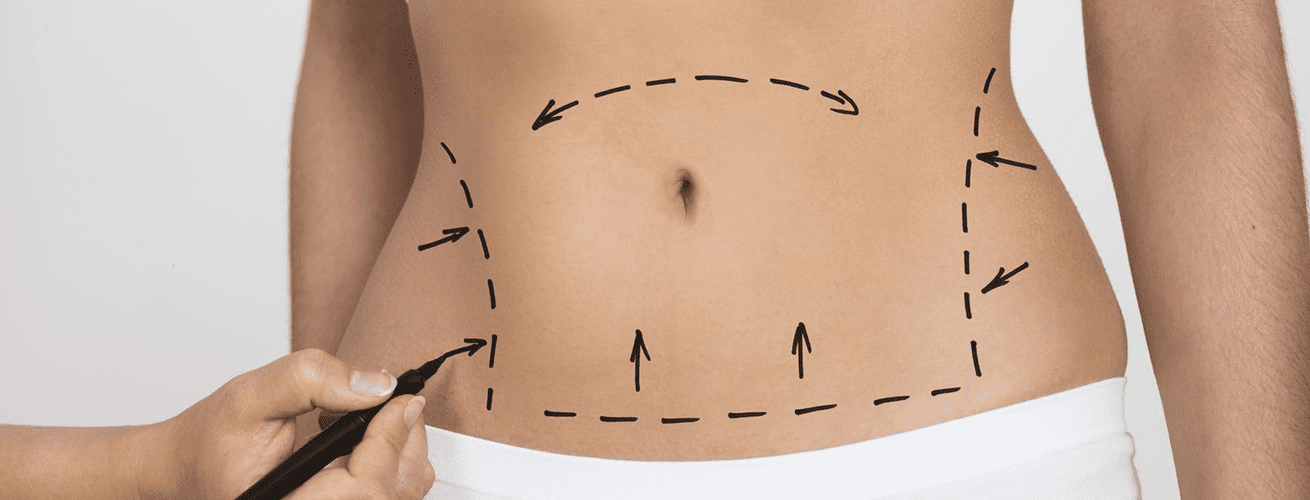 Saiba tudo sobre a abdominoplastia