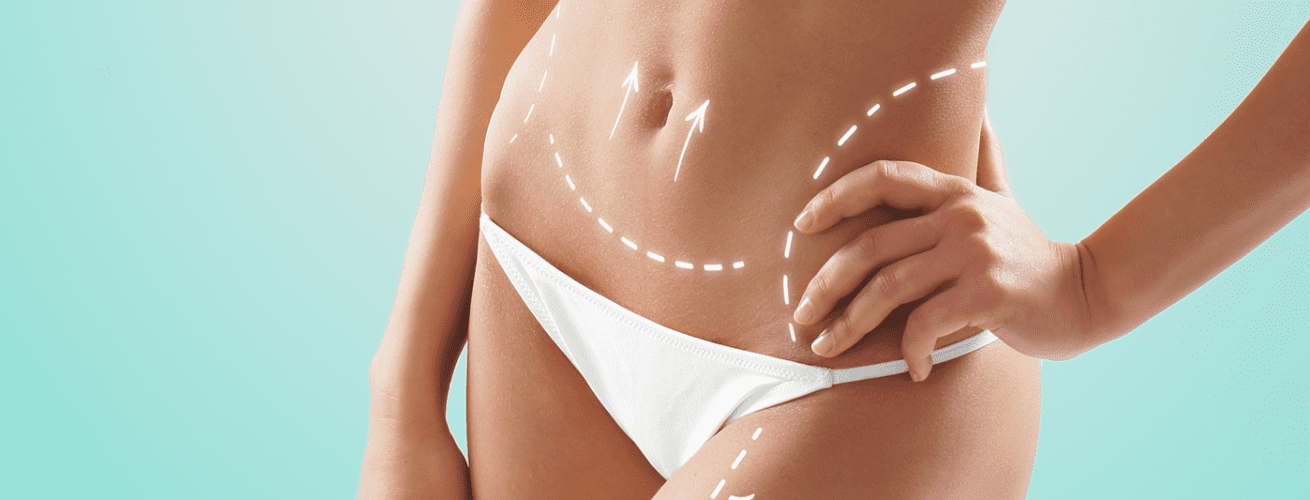 Abdominoplastia: conheça o procedimento